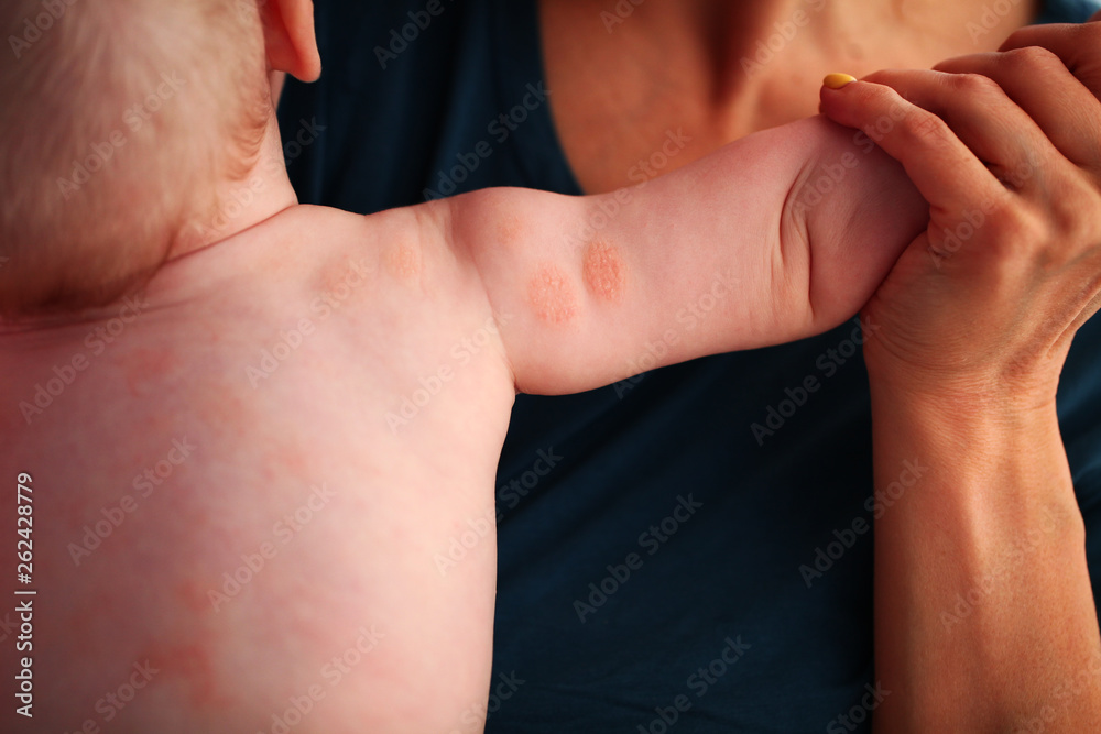 Naklejka premium Atopic dermatitis in a child