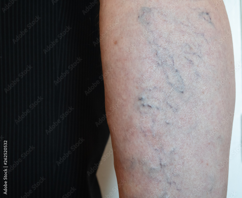 Fototapeta premium closeup of old man's leg with capillary mesh which cause varicose veins