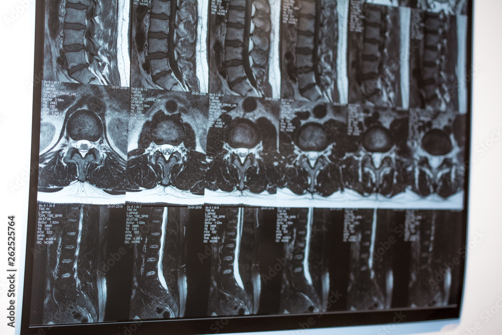 resonance tomography (MRT) of the lumbar spine. Hernia of the