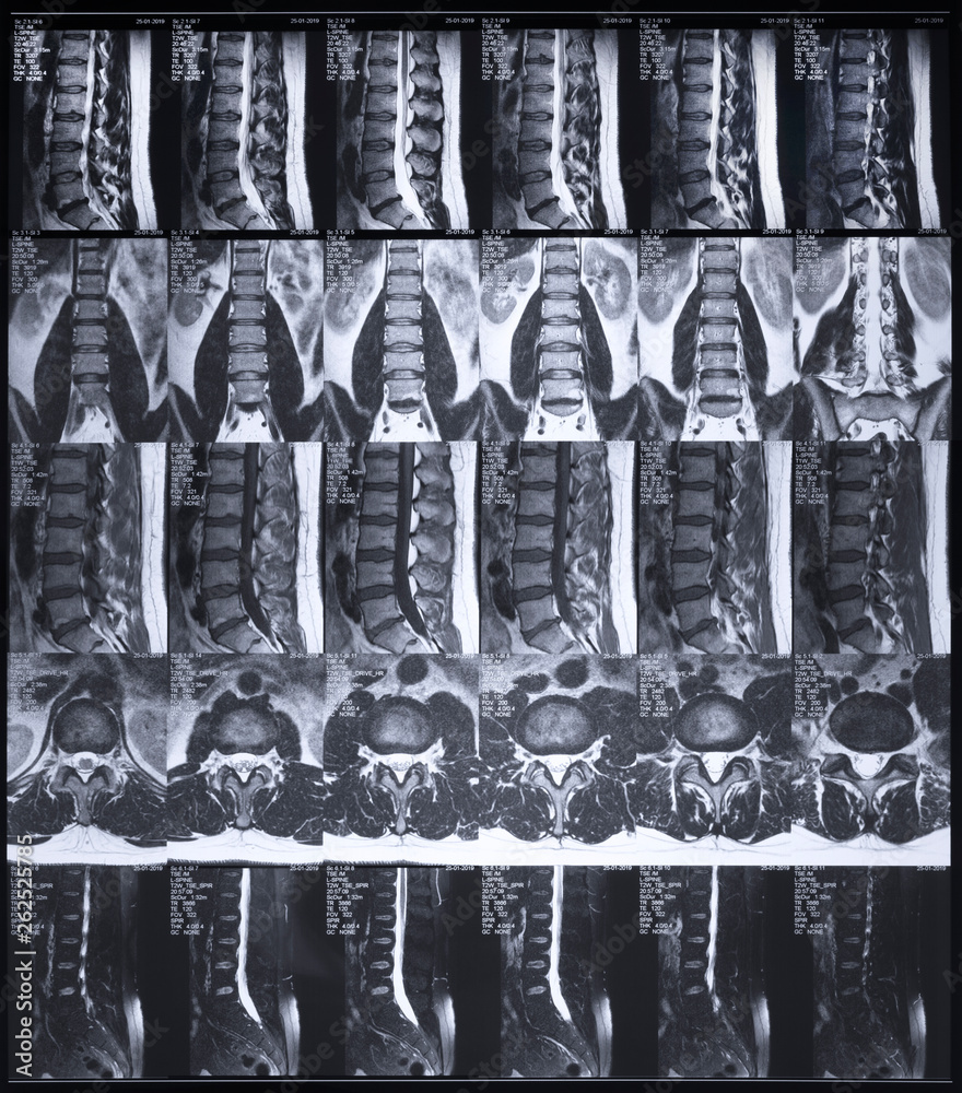 Foto de resonance tomography (MRT) of the lumbar spine. Hernia