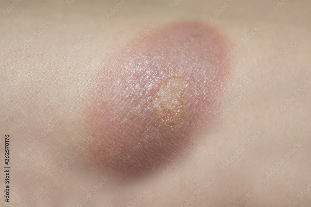 Fototapeta premium burn wound on woman skin