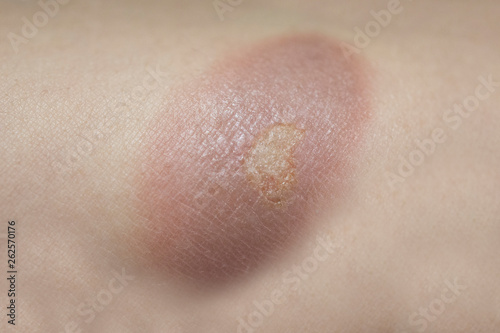 burn wound on woman skin