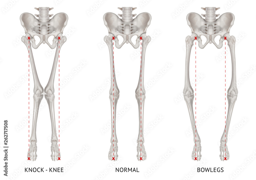 Alignment types disease leg bone problem of knock knee -Normal and Bowlegs  or valgus and varus knee- 3D Medical illustration- Human Anatomy and  Medical Concept-isolated on white background. Photos | Adobe Stock