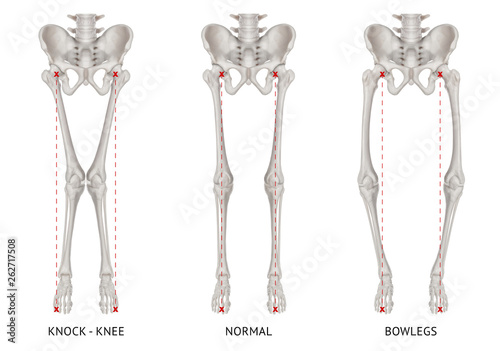Alignment types disease leg bone problem of knock knee -Normal and Bowlegs or valgus and varus knee- 3D Medical illustration- Human Anatomy and Medical Concept-isolated on white background.
