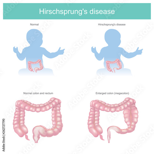 Hirschsprung's disease photo