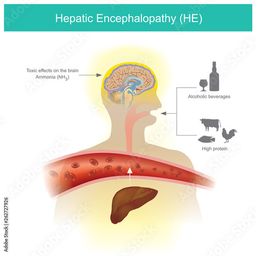 Hepatic Encephalopathy photo