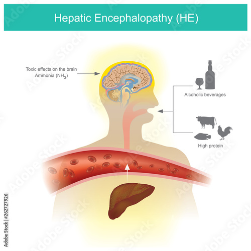 Hepatic Encephalopathy