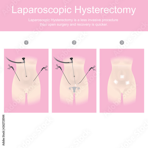 Laparoscopic hysterectomy is a less invasive procedure than open surgery and recovery is quicker.