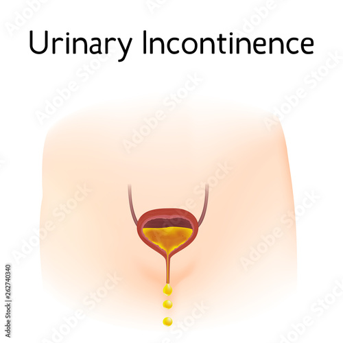 Anatomy picture of Urinary incontinence. Realistic medical illustration. Woman body silhoutte.