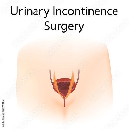 Anatomy picture of Urinary incontinence surgery. Realistic medical illustration. Woman body silhoutte.
