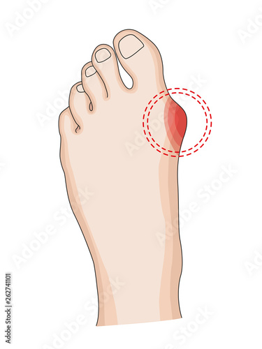Hallux