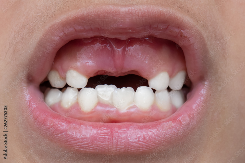 Fototapeta premium A close up view on the mouth of a young boy with missing incisors, childhood dentistry concept.