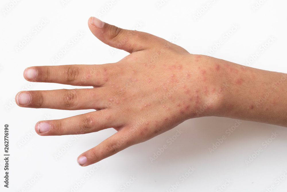 Dorsal view of a child’s hand and wrist with a spotty rash isolated against a white background. A common symptom of a virus in young children. Dorsal view of a child’s hand and wrist with a spotty rash isolated against a white background. A common symptom of a virus in young children.