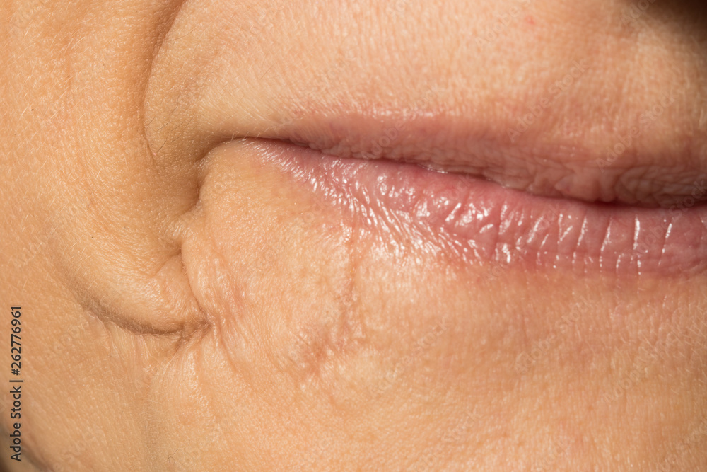Obraz premium An extreme closeup view of an old and well healed scar by the lips of a Caucasian woman, healthcare and surgery concept.