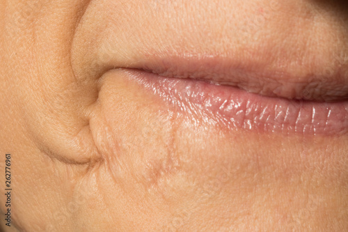 An extreme closeup view of an old and well healed scar by the lips of a Caucasian woman, healthcare and surgery concept.