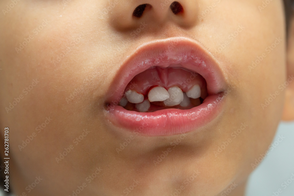 Naklejka premium A close up view on the mouth of a preschool child with loosened and bleeding front teeth. Childhood dentistry concept.
