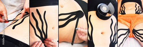 Принти на полотні Treatment of skin laxity using kinesiology taping