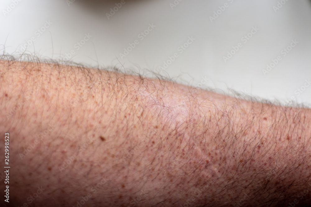 Naklejka premium old scar on hand