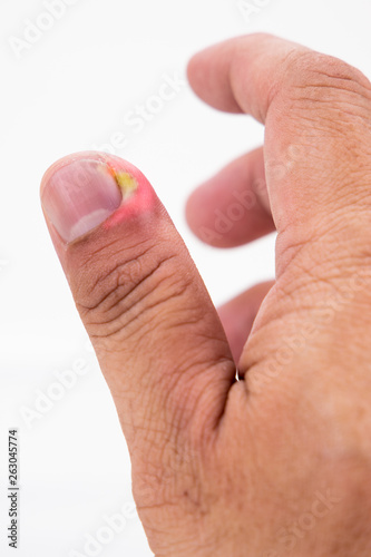 Series of painful finger nail skin infection with pus reatment