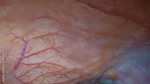 Endovideosurgery. Laparoscopy. View video camera inside the abdominal cavity of a sick patient.