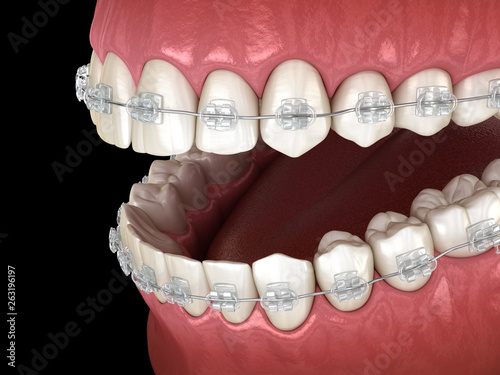 Teeth Clear braces in gums. Medically accurate dental 3D illustration