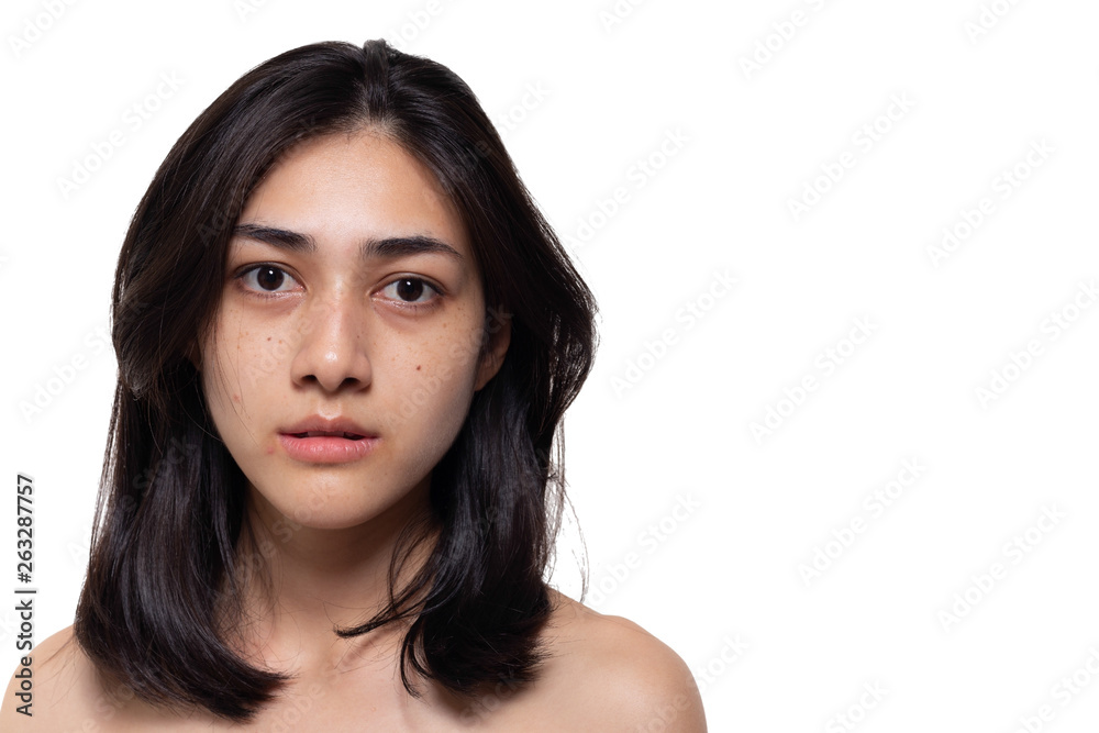 Beautiful asian woman gets freckles, blemish, pimple or acne and dull skin on her face. Charming beautiful young woman get problems of her skin. She looks unhappy. isolated on white, copy space Beautiful asian woman gets freckles, blemish, pimple or acne and dull skin on her face. Charming beautiful young woman get problems of her skin. She looks unhappy. isolated on white, copy space