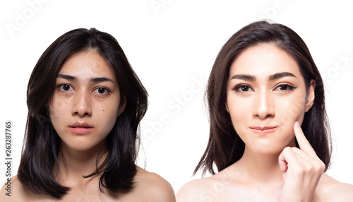 Cosmetology concept. Beautiful young asian woman has freckles, blemish, acne and dull skin, compare another side charming beautiful woman has nice and bright skin of face. Attractive girl get happy