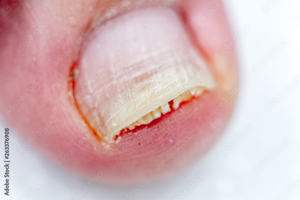 Onycholysis isolated on white background. Mechanical damage to the nail plate. Damage to the nail after applying shellac or gel-varnish (Gel-lacquer). Onycholysis isolated on white background. Mechanical damage to the nail plate. Damage to the nail after applying shellac or gel-varnish (Gel-lacquer).
