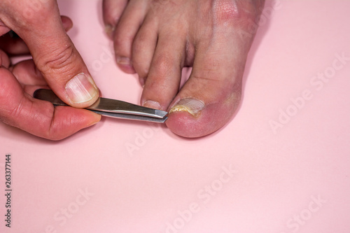 Onycholysis isolated on pink background. Mechanical damage to the nail plate. Damage to the nail after applying shellac or gel-varnish  Gel-lacquer .