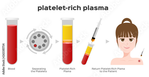 Platelet-Rich plasma procedure stages / prp / Centrifuge vector photo
