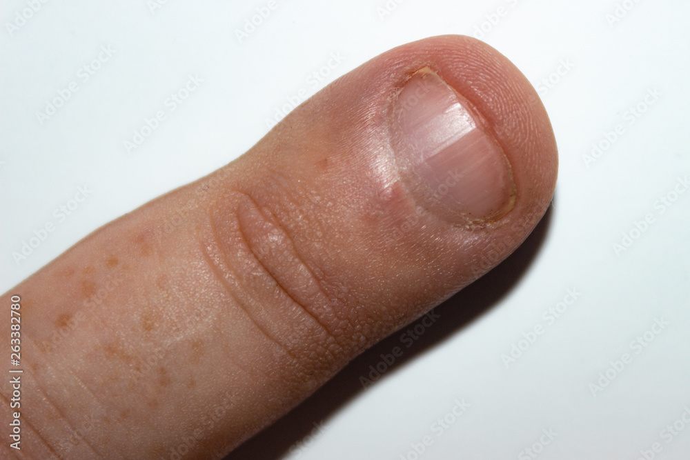 Fototapeta premium finger nail biting on white background