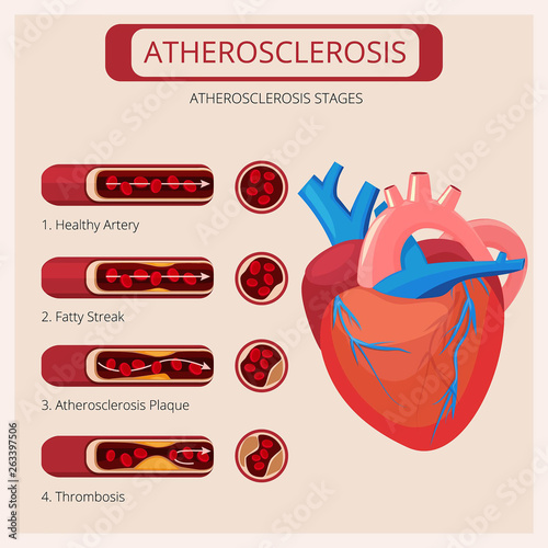 Atherosclerosis stages. Heart strokes thrombus attack blood circulatory system vector medical infographics. Cholesterol artery, heart human and cardiovascular system illustration