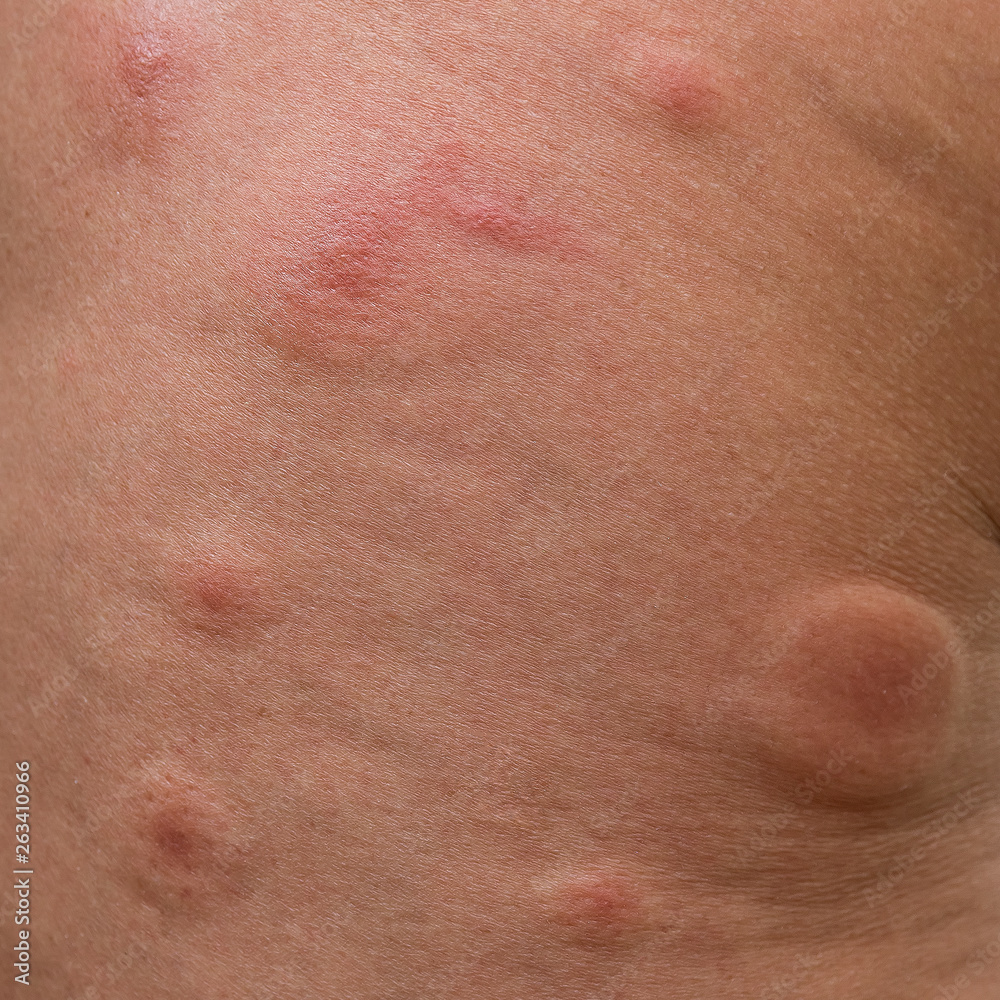 The traces of mosquito bites on human skin. On the need to protect against mosquitoes.