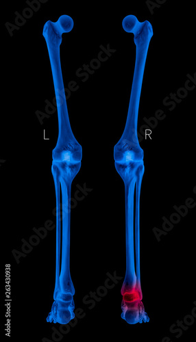 X-ray of Human Leg bone posterior view red highlights in arthritis leg Ankle pain area- 3D Medical and Biomedical illustration- Healthcare- Human Anatomy and Medical Concept- Blue tone color