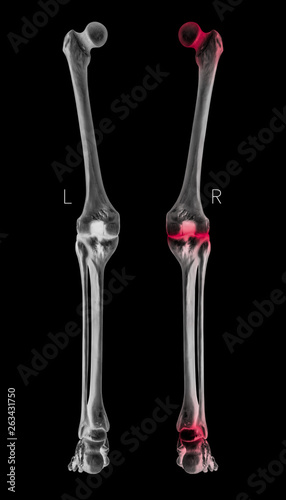X-ray of Human Leg bone posterior view red highlights in arthritis leg joint pain area- 3D Medical and Biomedical illustration- Healthcare- Human Anatomy and Medical Concept- Black and white color