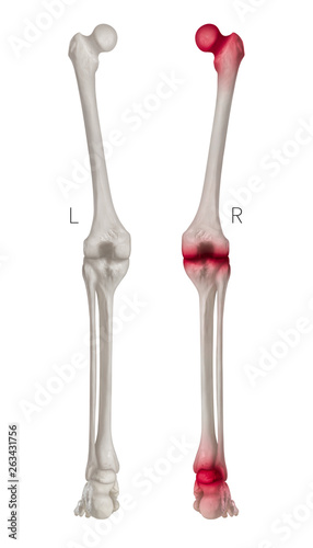 Human Leg bone left and right- Posterior view red highlights in arthritis leg joint pain area- 3D Medical- Biomedical illustration- Human Anatomy and Medical Concept- Isolated white background