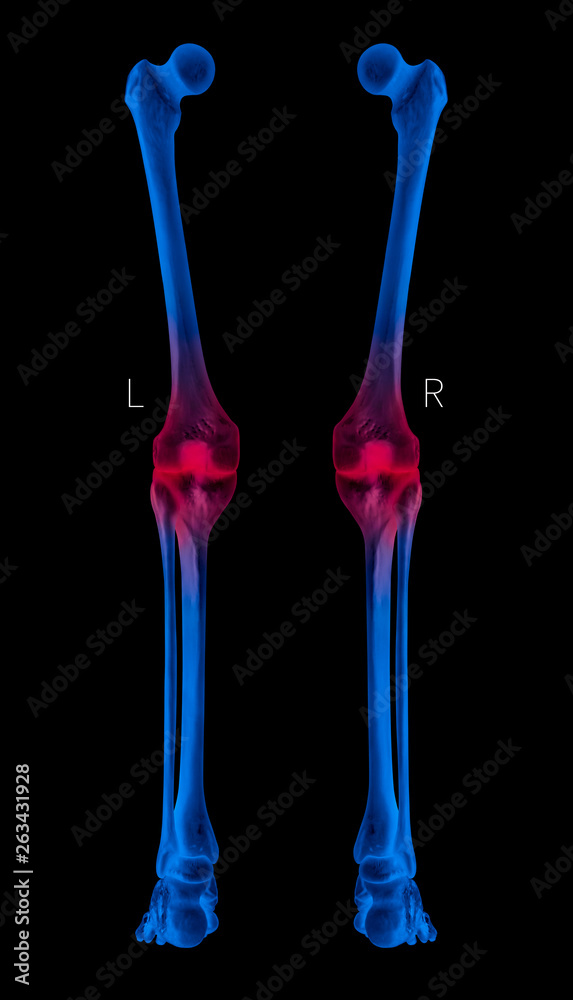 X-ray of Human Leg bone posterior view red highlights in arthritis Knee bone joint pain area- 3D Medical and Biomedical illustration- Healthcare- Human Anatomy and Medical Concept- Blue tone color X-ray of Human Leg bone posterior view red highlights in arthritis Knee bone joint pain area- 3D Medical and Biomedical illustration- Healthcare- Human Anatomy and Medical Concept- Blue tone color