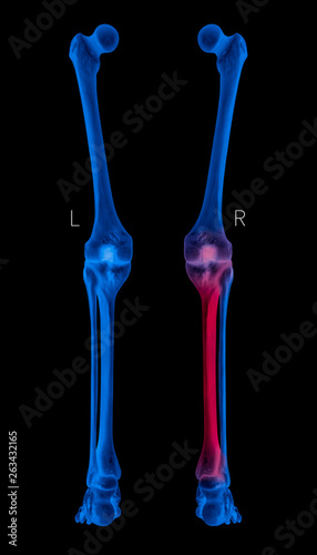 X-ray of Human Leg bone left and right- Posterior view red highlights in Tibia bone pain area-3D Medical and Biomedical illustration-Healthcare-Human Anatomy and Medical Concept- Blue tone color
