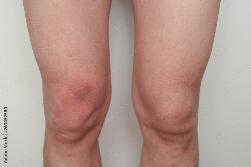 A front view of knee bruising which has been caused by unnoticed