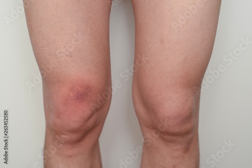 A front view of knee bruising which has been caused by unnoticed bumping. A common side effect of aspirin intake.