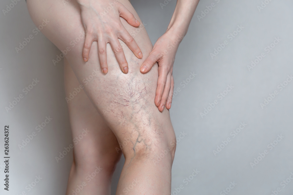 Woman shows leg with varicose veins. The concept of human health and disease. Gray background - obrazy, fototapety, plakaty 