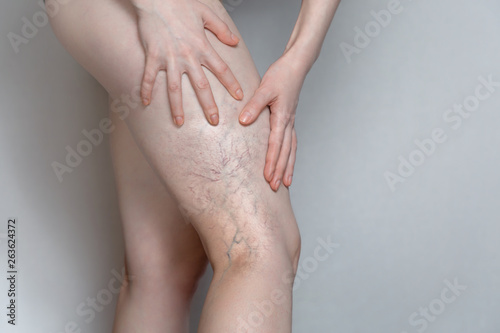Woman shows leg with varicose veins. The concept of human health and disease. Gray background photo