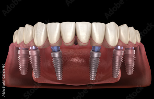 Mandibular prosthesis All on 6 system supported by implants. Medically accurate 3D illustration of human teeth and dentures concept photo