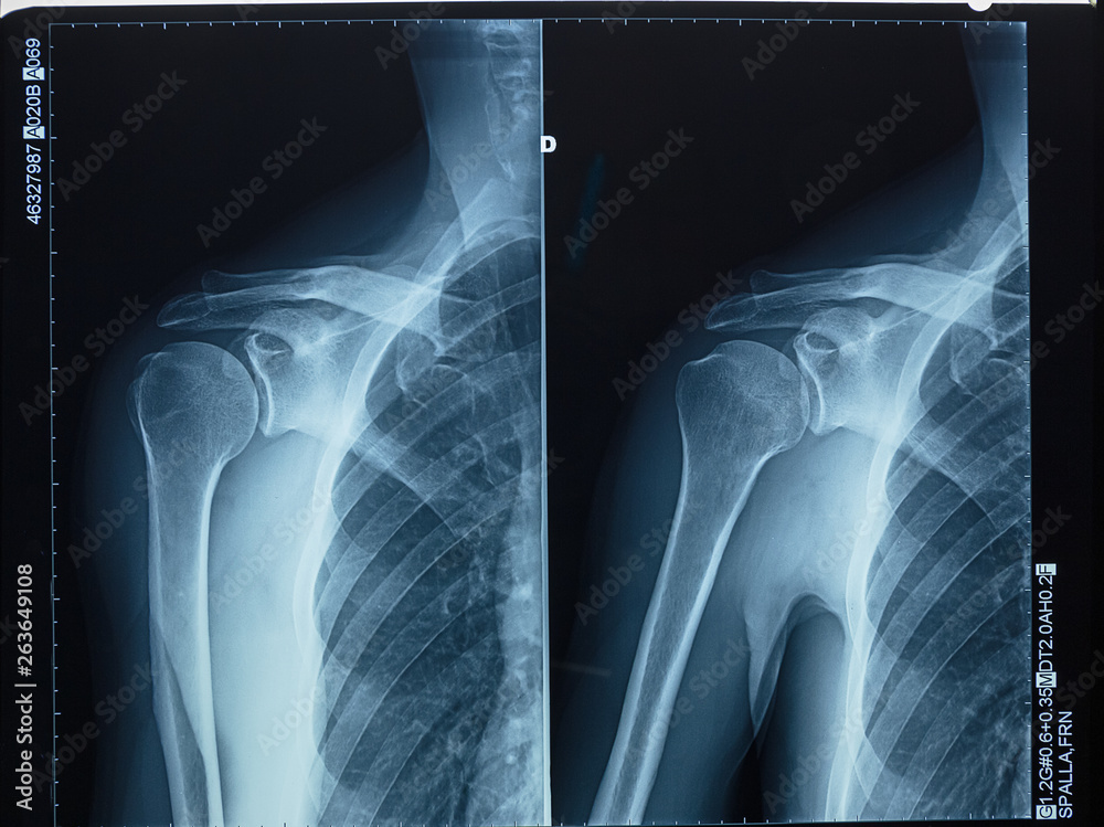Detail of x-ray of human shoulder bones