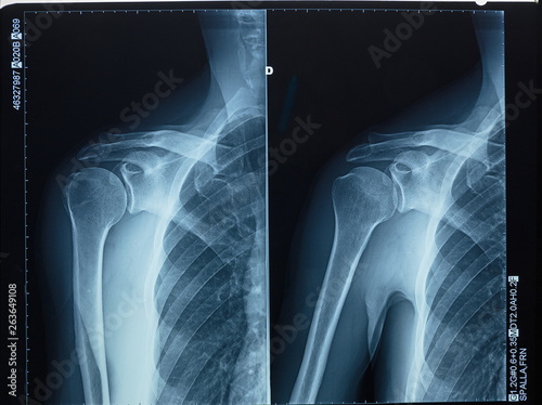 Detail of x-ray of human shoulder bones