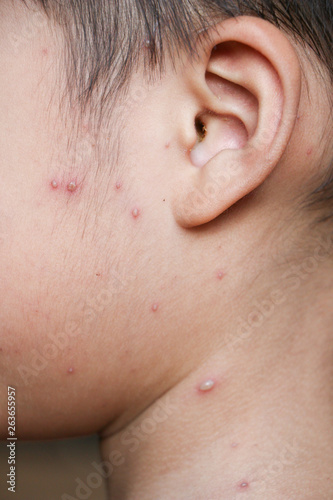 Chicken pox rash on young boy body.Chickenpox is an infection caused by the varicella zoster virus. It begins as a blister-like rash that originates on the face and trunk