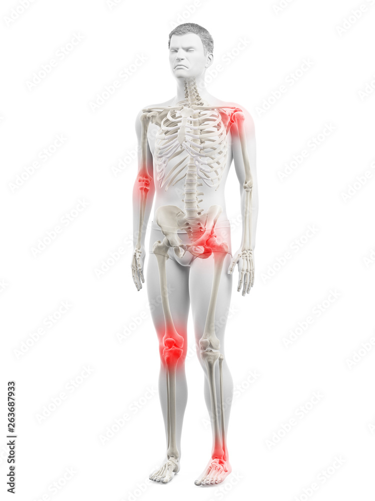 3d rendered medically accurate illustration of a mans painful joints