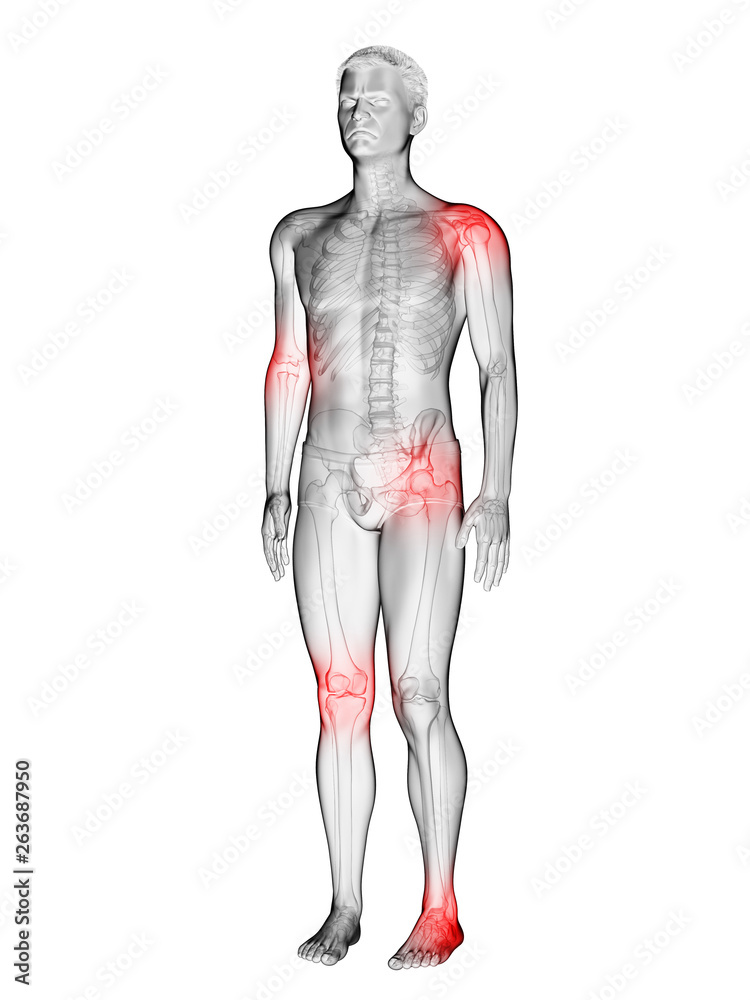 3d rendered medically accurate illustration of a mans painful joints