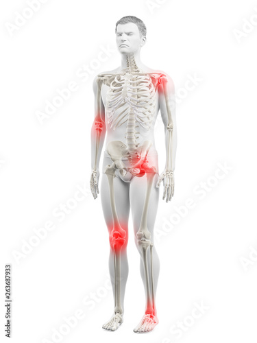 3d rendered medically accurate illustration of a mans painful joints