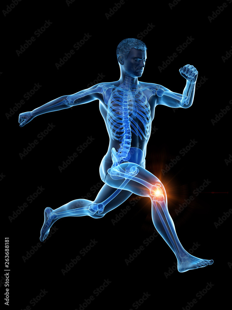 3d rendered medically accurate illustration of a runners painful kee